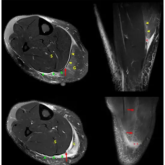 MRI Scan Right Calf | Medintu