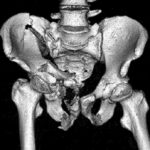 3D CT Scan Pelvis