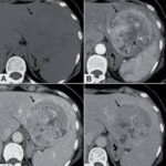 CECT Biphasic/Triphasic Whole Abdomen