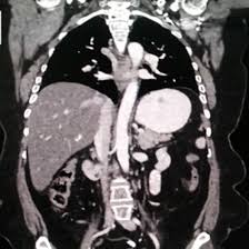 CECT Chest Upper Abdomen