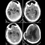 CECT Head Scan