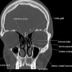 CECT Head With PNS