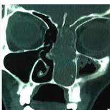 CECT PNS Coronal