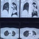 CECT Thorax
