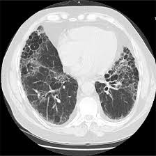 CECT Thorax and HRCT Cut