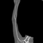 CT Angiography Arterial Upper Limb