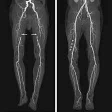 CT Angiography Arteries Lower Limb