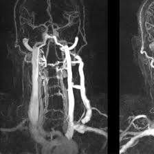 CT Angiography Neck Vessels