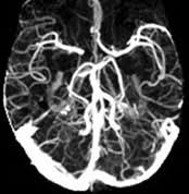 CT Brain Angiography