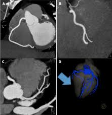 CT Coronary Angiography