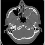 CT Head and PNS Coronal