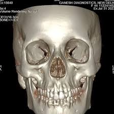 CT Orbit 3D Reconstruction