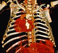 CT Scan Chest 3D