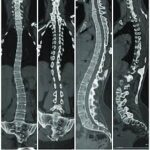 CT Scan Whole Spine