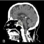 CT Sella Axial and Coronal