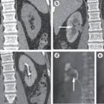 CT Urography