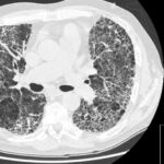 HRCT Chest Scan