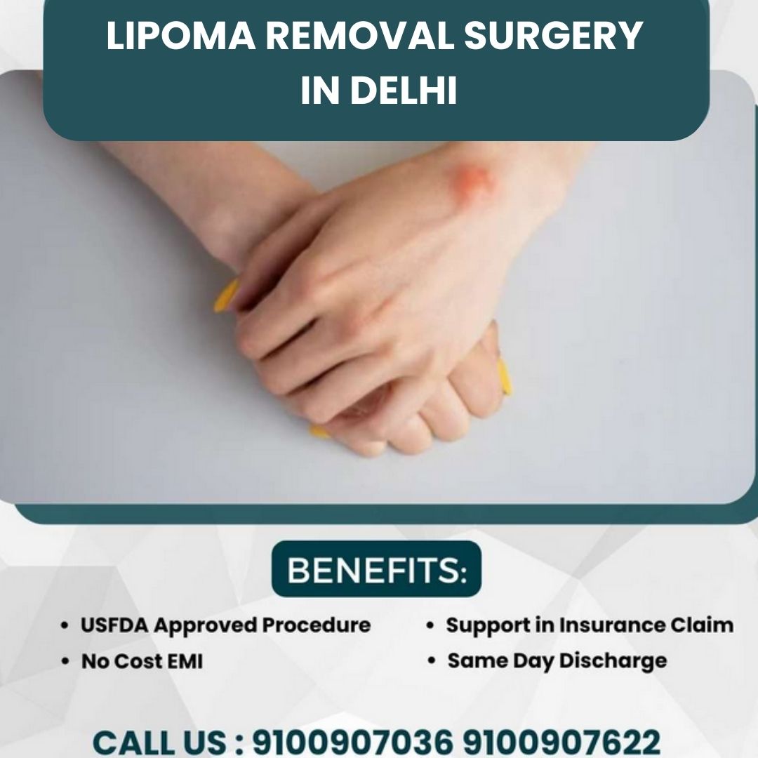 LIPOMA REMOVAL SURGERY IN DELHI