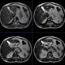 MRCP With Contrast
