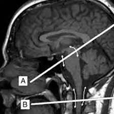 MRI CSF Flow Study