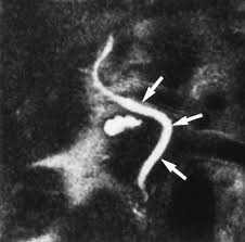 MRI Cholangiogram
