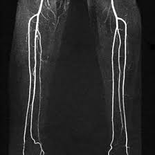 MRI Extremities With Contrast