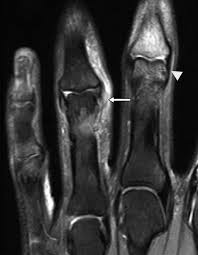 MRI Finger