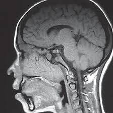 MRI For Nasal Area