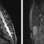 MRI LS Spine Flexion