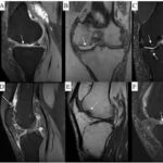 MRI Left Knee With Cartigram