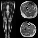 MRI Lower Limb