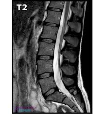 MRI Lumber Sacral (LS) Spine