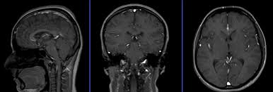 MRI Multiple Sclerosis Protocol