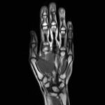 MRI Palm