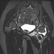 icd 10 code for mri left hip without contrast
