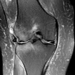 MRI Right Knee Joint
