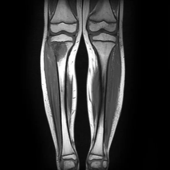 MRI Right Tibia