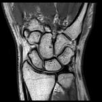 MRI Right Wrist