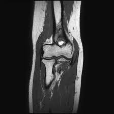 MRI Screening Arm With Elbow