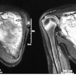 MRI Screening Of Both Scapula