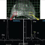 MRI Spectroscopy Prostate