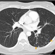 NCCT Thorax