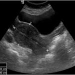 Pelvis Ultrasound