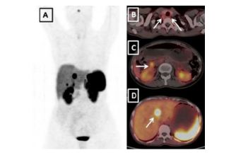 Dotanoc PET CT