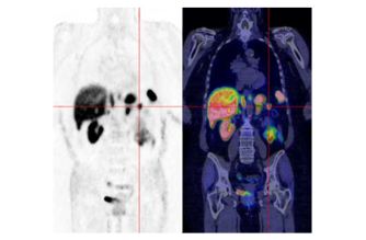 Dotatate PET CT