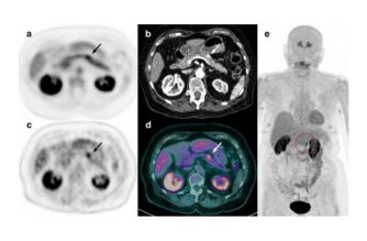 Fdopa PET CT