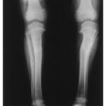 X-Ray Exam : Lower Leg (Tibia and Fibula)
