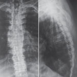 X-ray Dorsal Lumbar Spine AP View