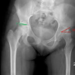 X-ray Right Hip Joint