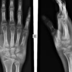 X-ray Right Wrist AP/LAT